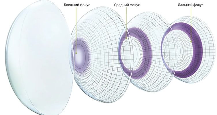 Почему выбирают мультифокальные линзы при пресбиопии и возрастных изменениях зрения 