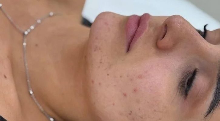 Анна Трінчер показала обличчя з акне та розкрила шлях до ремісії 